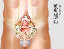 前列腺炎