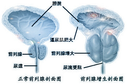 欽州男性前列腺增生的致病因素有哪些